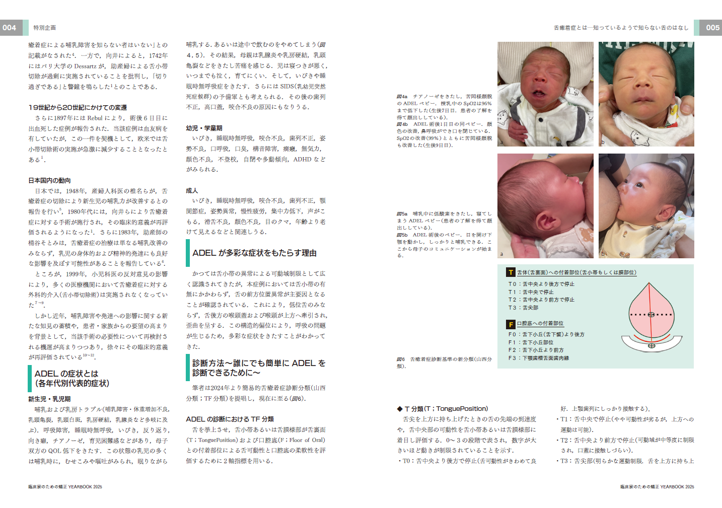 舌癒着症論文