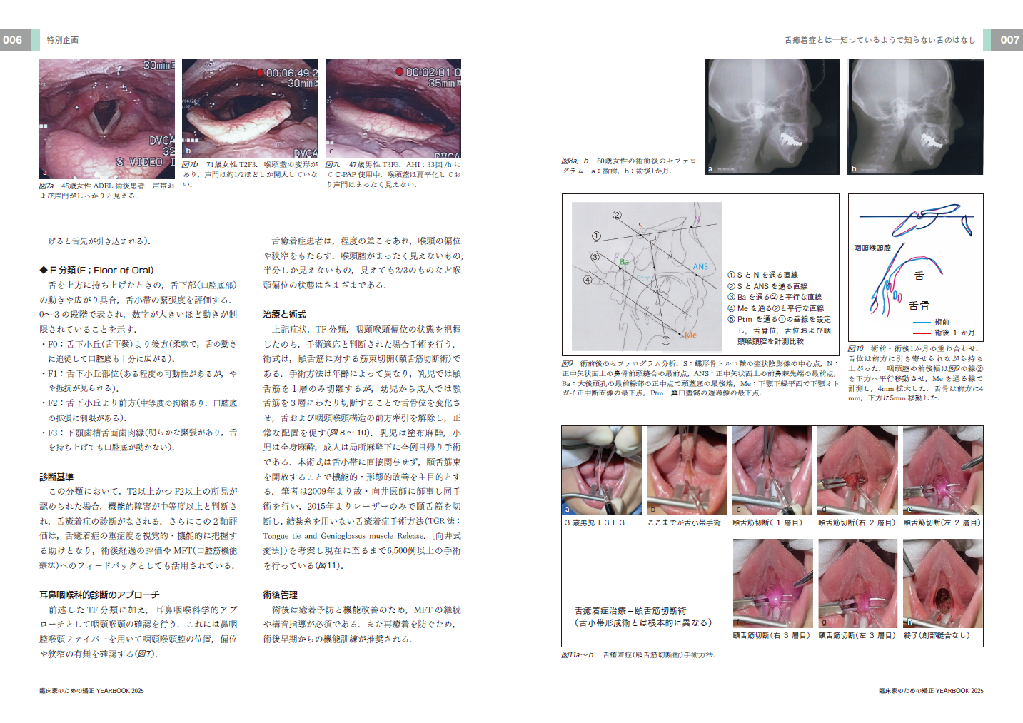 舌癒着症論文