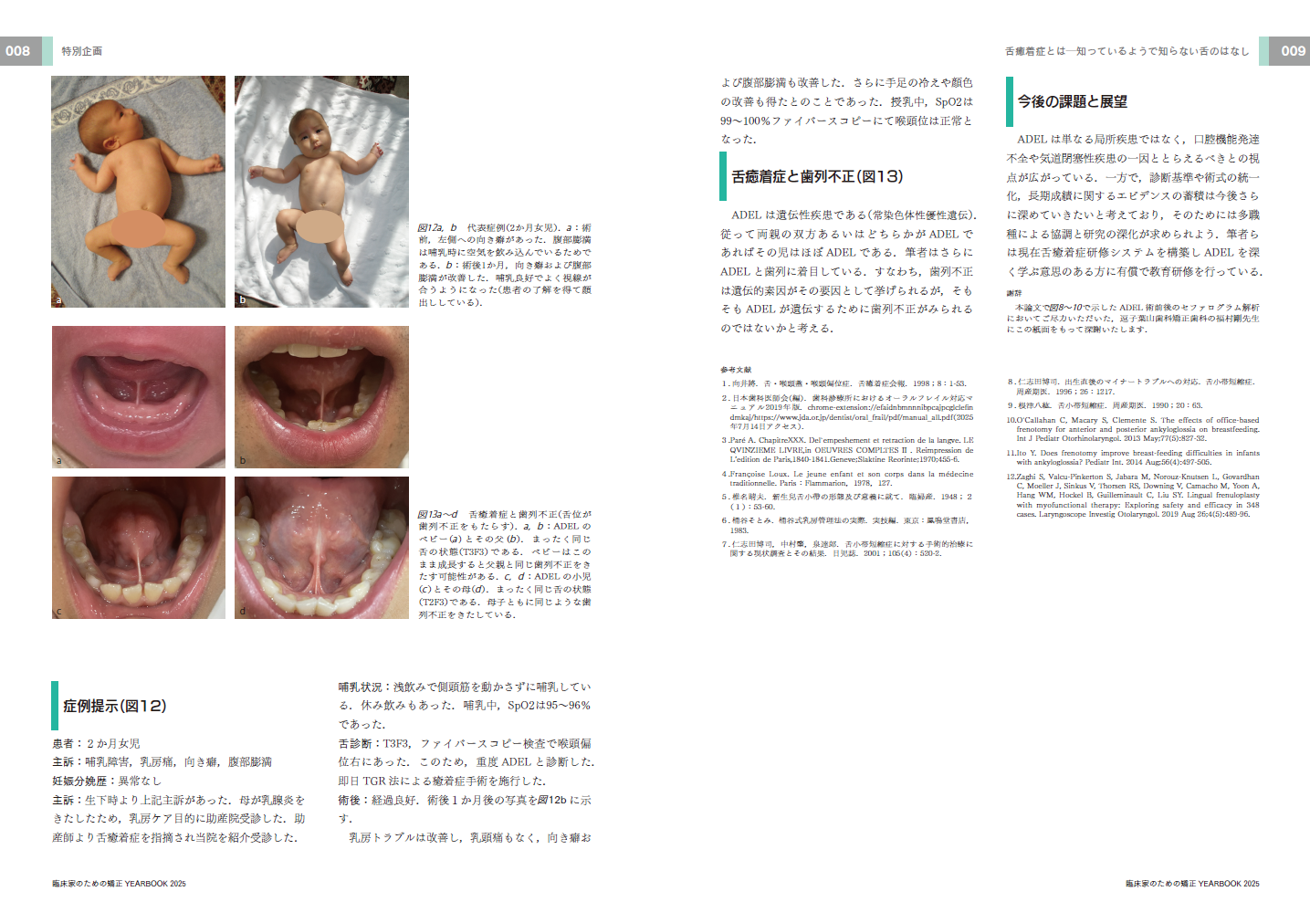 舌癒着症論文
